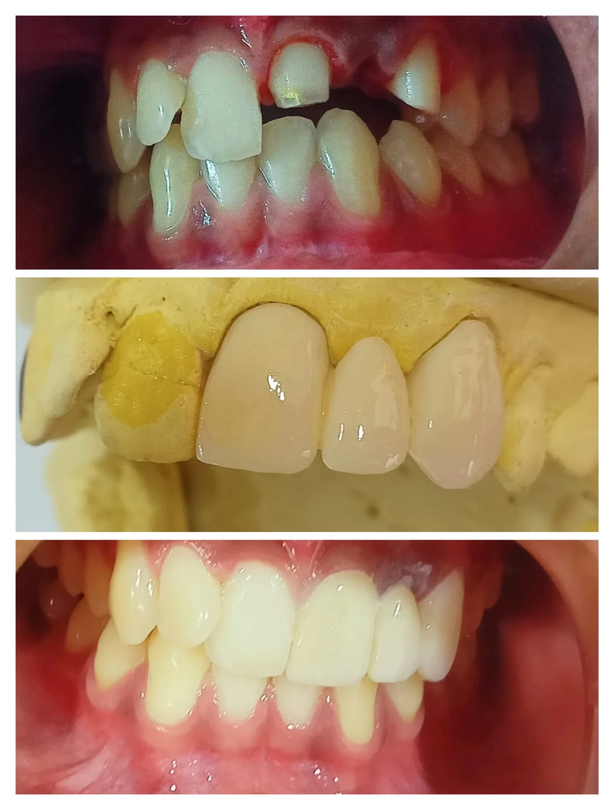 Anterior Smile Correction #5